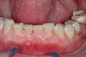 Composite restorations